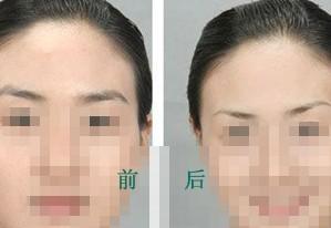 <a href=http://m.f3bb6.cn/listinfo-655-0.html target=_blank class=infotextkey>切眉</a>術的手術過程步驟及術后護理？