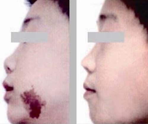 海淀激光<a href=http://m.f3bb6.cn/listinfo-773-0.html target=_blank class=infotextkey>去胎記</a>手術后遺癥