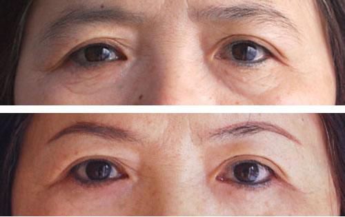提眉術恢復自然需要多久呢？