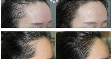 半長期紋發際線多少錢?