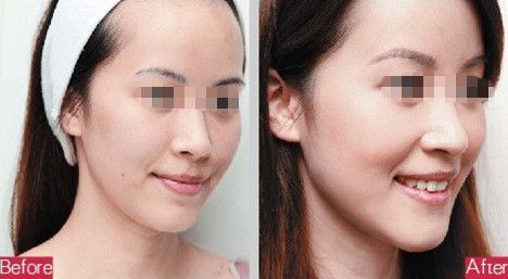 全臉脂肪填充第5天效果怎么樣