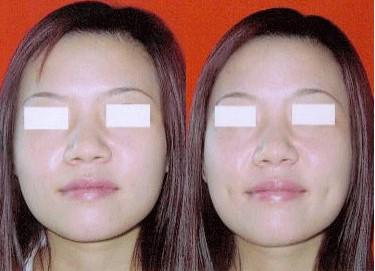 酒窩成形術(shù)的價(jià)格