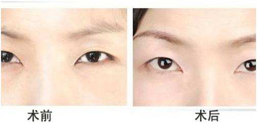 <a href=http://m.f3bb6.cn/listinfo-655-0.html target=_blank class=infotextkey>切眉</a>術后快速消腫的方法有哪些？