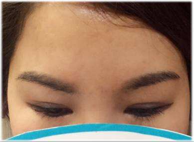 <a href=http://m.f3bb6.cn/listinfo-655-0.html target=_blank class=infotextkey>切眉</a>術術后護理要點有哪些？