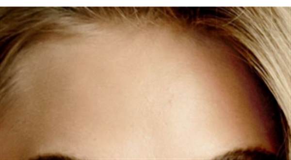 發際線整形的費用是多少