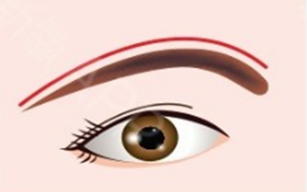 提眉術(shù)的手術(shù)設(shè)計操作怎樣？