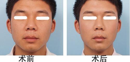 <a href=http://m.f3bb6.cn/listinfo-655-0.html target=_blank class=infotextkey>切眉</a>手術(shù)后老得快