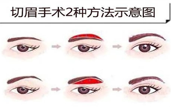 哪些人適合做<a href=http://m.f3bb6.cn/listinfo-655-0.html target=_blank class=infotextkey>切眉</a>術(shù)呢？