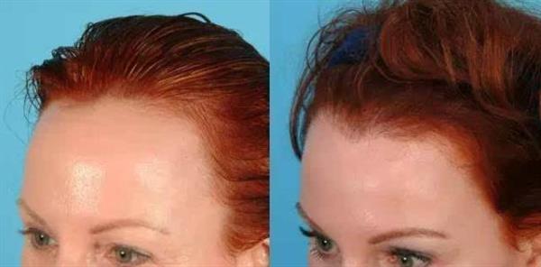 發(fā)際線后移怎么治療