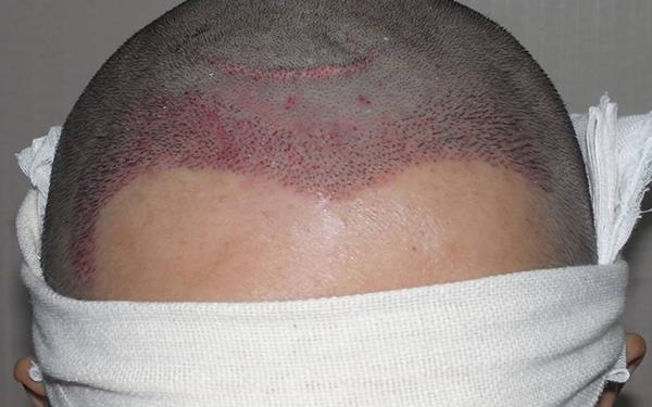 發際線高怎么辦