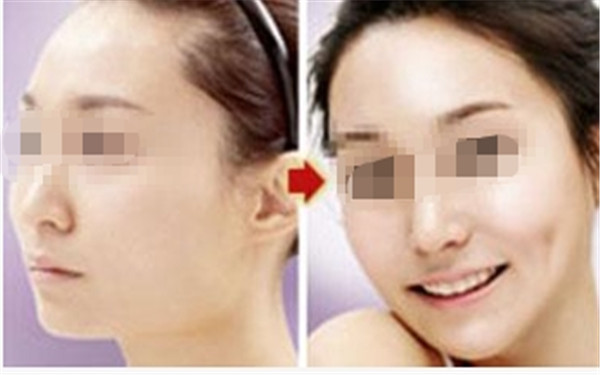 人造酒窩效果好嗎？