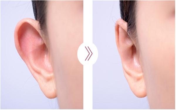 做招風耳手術多少錢