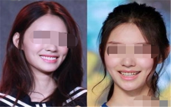  整一個(gè)酒窩要多少錢