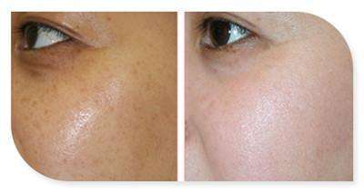 詳解關于臉部色素沉著的治療方法