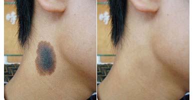 黑色胎記去掉多少錢