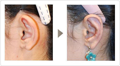 <a href=http://m.f3bb6.cn/listinfo-698-0.html target=_blank class=infotextkey>招風(fēng)耳矯正</a>是如何手術(shù)的呢