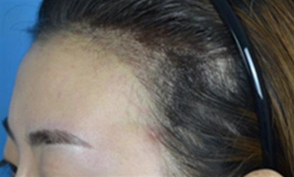 發(fā)際線高怎么辦真的有必要去做手術(shù)么