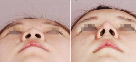 韓式<a href=http://m.f3bb6.cn/listinfo-737-0.html target=_blank class=infotextkey>隆鼻</a>真人前后對(duì)比