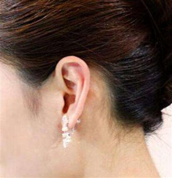 耳廓再造手術效果如何