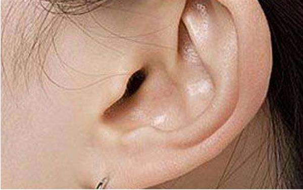 杯狀耳整形術(shù)效果如何