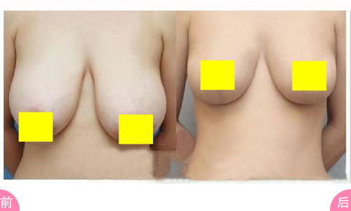 <a href=http://m.f3bb6.cn/listinfo-617-0.html target=_blank class=infotextkey>巨乳縮小</a>術(shù)的方法有那些