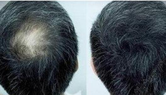 如何擺脫禿頭的困擾？