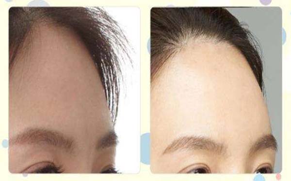 發(fā)際線怎么整