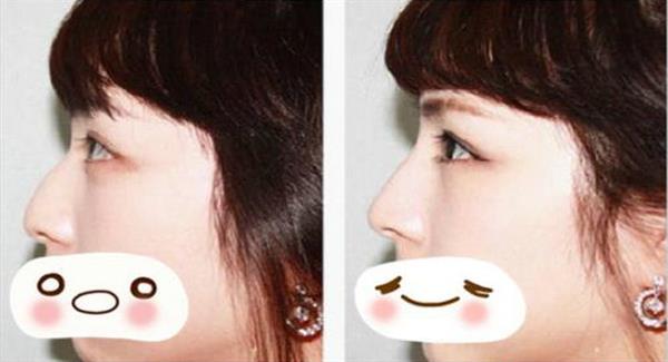 韓式<a href=http://m.f3bb6.cn/listinfo-737-0.html target=_blank class=infotextkey>隆鼻</a>術(shù)前及術(shù)后的護(hù)理療程