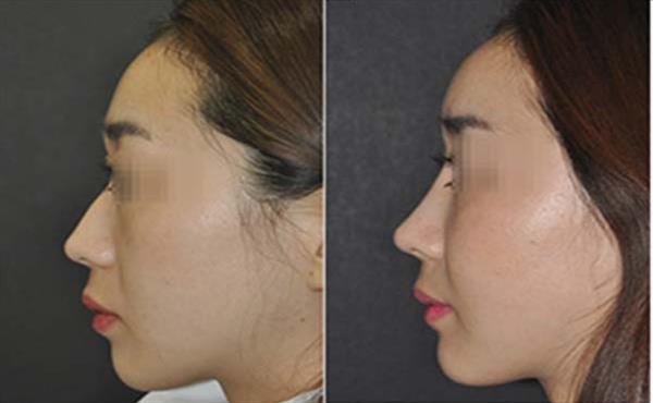 做韓式<a href=http://m.f3bb6.cn/listinfo-737-0.html target=_blank class=infotextkey>隆鼻</a>前的準(zhǔn)備有哪些