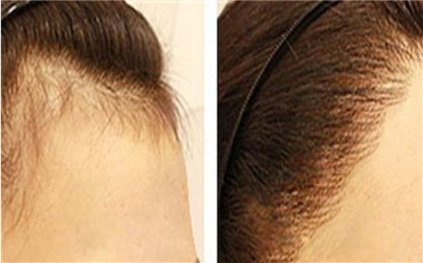 整發際線多久能恢復好