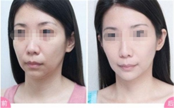  注射祛皺效果怎么樣呢？