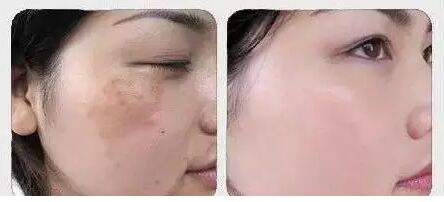 激光黃褐斑要多少錢