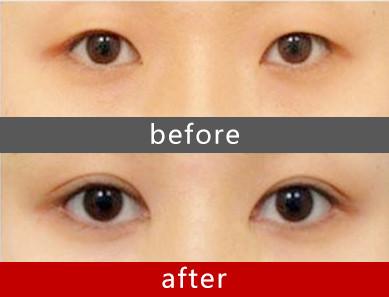 全切<a href=http://m.f3bb6.cn/listinfo-724-0.html target=_blank class=infotextkey>雙眼皮</a>恢復期需要多長時間