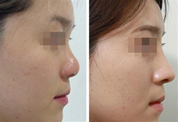 假體<a href=http://m.f3bb6.cn/listinfo-737-0.html target=_blank class=infotextkey>隆鼻</a>的假體形狀及效果