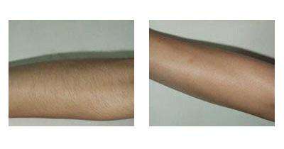 做激光<a href=http://m.f3bb6.cn/listinfo-670-0.html target=_blank class=infotextkey>脫毛</a>有不良反應出現嗎