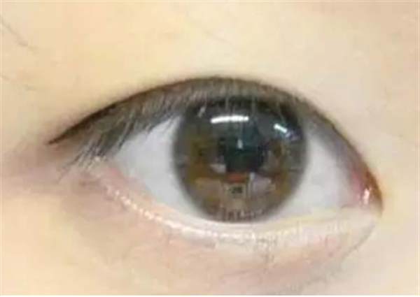 熱效<a href=http://m.f3bb6.cn/listinfo-682-0.html target=_blank class=infotextkey>溶脂</a><a href=http://m.f3bb6.cn/listinfo-708-0.html target=_blank class=infotextkey>去眼袋</a>后凹陷怎么治療