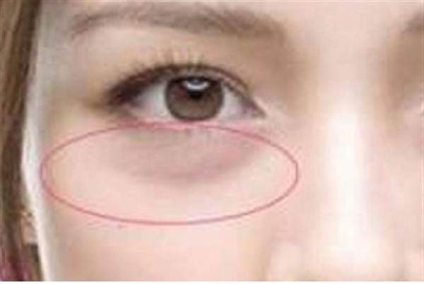 熱效<a href=http://m.f3bb6.cn/listinfo-682-0.html target=_blank class=infotextkey>溶脂</a><a href=http://m.f3bb6.cn/listinfo-708-0.html target=_blank class=infotextkey>去眼袋</a>的缺點(diǎn)有什么