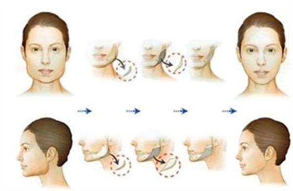 做<a href=http://m.f3bb6.cn/listinfo-629-0.html target=_blank class=infotextkey>下頜角</a>矯正要價格