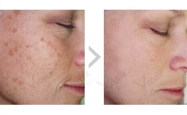 激光去老年斑前后對比