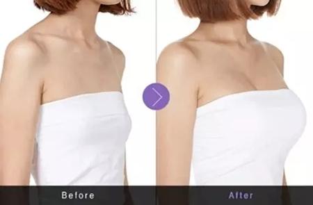 假體<a href=http://m.f3bb6.cn/listinfo-618-0.html target=_blank class=infotextkey>隆胸</a>的利弊