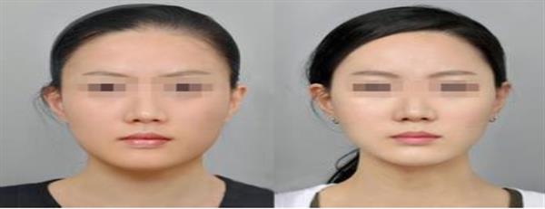 打<a href=http://m.f3bb6.cn/listinfo-631-0.html target=_blank class=infotextkey>瘦臉</a><a href=http://m.f3bb6.cn/listinfo-614-0.html target=_blank class=infotextkey>除皺</a>注意事項