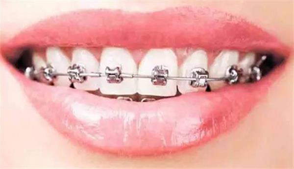 牙套主要有哪些分類