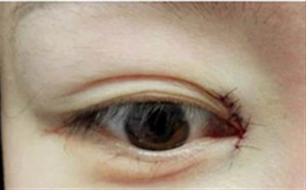 <a href=http://m.f3bb6.cn/listinfo-711-0.html target=_blank class=infotextkey>開眼角</a>恢復過程怎么樣