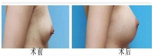 胸部<a href=http://m.f3bb6.cn/listinfo-685-0.html target=_blank class=infotextkey>吸脂</a><a href=http://m.f3bb6.cn/listinfo-618-0.html target=_blank class=infotextkey>隆胸</a>的手術(shù)操作及術(shù)后護理