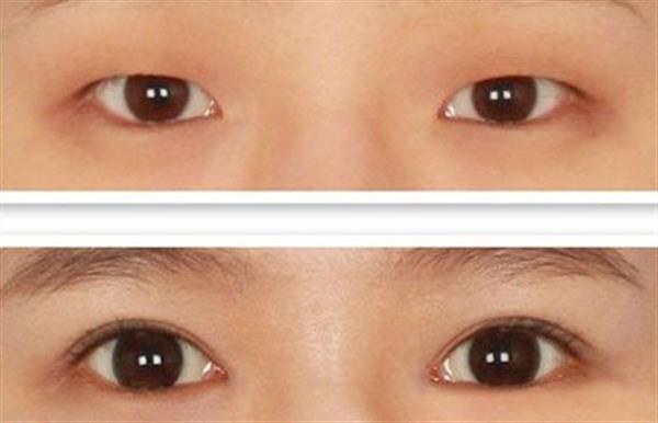 割<a href=http://m.f3bb6.cn/listinfo-724-0.html target=_blank class=infotextkey>雙眼皮</a>幾個(gè)月定型