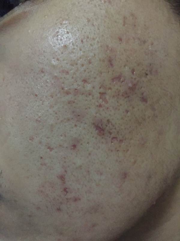 水痘凹疤修復(fù)要多錢