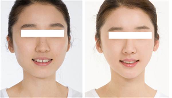 假體下巴多久變軟