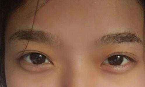 透明質(zhì)酸做<a href=http://m.f3bb6.cn/listinfo-722-0.html target=_blank class=infotextkey>臥蠶</a>手術效果怎么樣