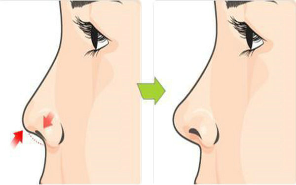 目前較安全的<a href=http://m.f3bb6.cn/listinfo-737-0.html target=_blank class=infotextkey>隆鼻</a>術