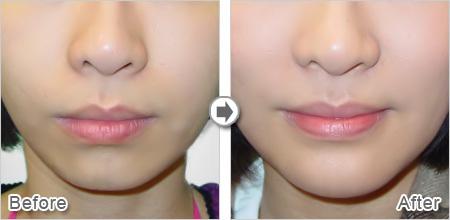 不手術怎么豐下巴